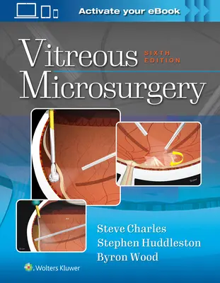 Üveghártya mikrosebészet - Vitreous Microsurgery