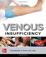 Vénás elégtelenség - Venous Insufficiency