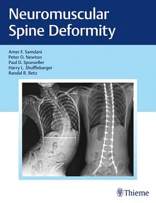 Neuromuszkuláris gerincdeformitás - Neuromuscular Spine Deformity