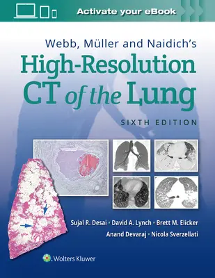 Webb, Mller és Naidich nagyfelbontású CT-je a tüdőről - Webb, Mller and Naidich's High-Resolution CT of the Lung