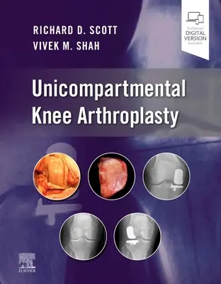 Unicompartmentális térdprotézisek - Unicompartmental Knee Arthroplasty