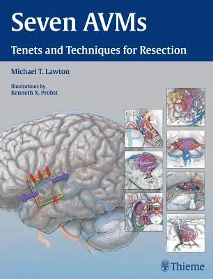 Seven Avms: Tantételek és technikák a rezekcióhoz - Seven Avms: Tenets and Techniques for Resection