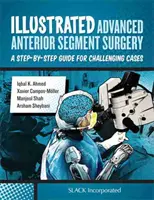 Illusztrált fejlett elülső szegmentumsebészet: A Step-By-Step Guide for Challenging Cases: A Step-By-Step Guide for Challenging Cases (Lépésről lépésre útmutató a kihívást jelentő esetekhez) - Illustrated Advanced Anterior Segment Surgery: A Step-By-Step Guide for Challenging Cases