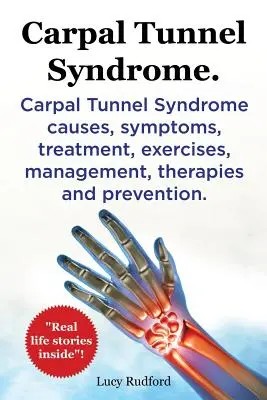 Carpalis alagút szindróma, Cts. Carpalis alagút szindróma Cts okok, tünetek, kezelés, gyakorlatok, kezelés, terápiák és megelőzés. - Carpal Tunnel Syndrome, Cts. Carpal Tunnel Syndrome Cts Causes, Symptoms, Treatment, Exercises, Management, Therapies and Prevention.