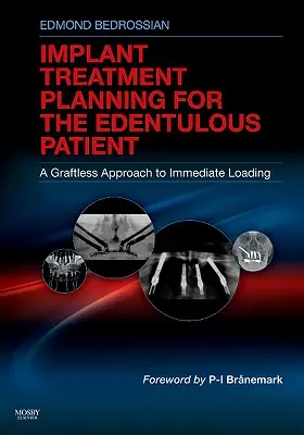 Implantációs kezelés tervezése a fogatlan páciensek számára: A graft nélküli megközelítés az azonnali terheléshez - Implant Treatment Planning for the Edentulous Patient: A Graftless Approach to Immediate Loading