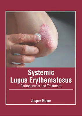 Szisztémás lupus erythematosus: Lupus lupusosus lupus: Patogenezis és kezelés - Systemic Lupus Erythematosus: Pathogenesis and Treatment