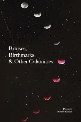 Zúzódások, anyajegyek és más csapások - Bruises, Birthmarks & Other Calamities