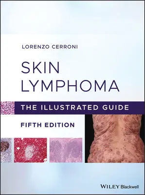Bőrlimfóma: Az illusztrált útmutató - Skin Lymphoma: The Illustrated Guide