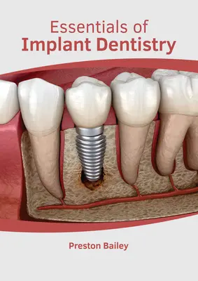 Az implantációs fogászat alapjai - Essentials of Implant Dentistry