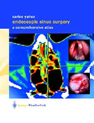 Endoszkópos arcüregsebészet: A Comprehensive Atlas - Endoscopic Sinus Surgery: A Comprehensive Atlas