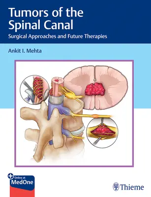 A gerinccsatorna daganatai: A daganatos tumorok: Sebészeti megközelítések és jövőbeli terápiák - Tumors of the Spinal Canal: Surgical Approaches and Future Therapies