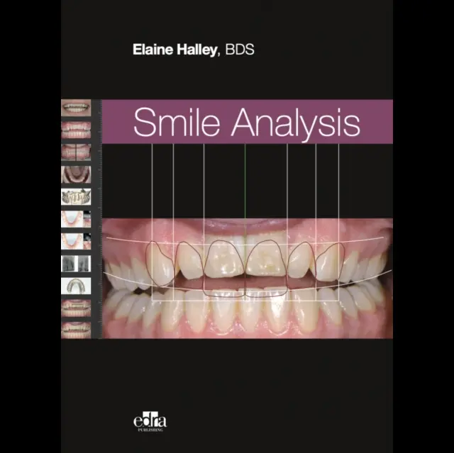 Mosoly elemzése - Smile Analysis