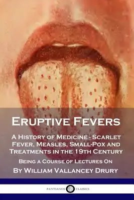 Kitörő lázak: A History of Medicine - Scarlet Fever, Measles, Small-Pox and Treatments in the 19th Century - Being a Course of Lectu - Eruptive Fevers: A History of Medicine - Scarlet Fever, Measles, Small-Pox and Treatments in the 19th Century - Being a Course of Lectu