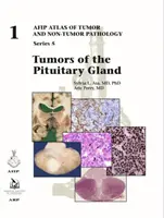 Az agyalapi mirigy daganatai - Tumors of the Pituitary Gland