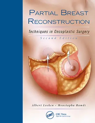 Részleges mellrekonstrukció: Az onkoplasztikai sebészet technikái - Partial Breast Reconstruction: Techniques in Oncoplastic Surgery