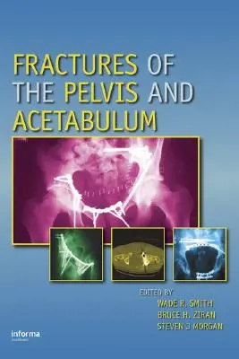 A medence és a csípőcsont törései - Fractures of the Pelvis and Acetabulum