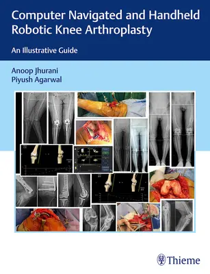 Számítógépes navigált és kézi robotizált térdprotézisek: Egy szemléltető útmutató - Computer Navigated and Handheld Robotic Knee Arthroplasty: An Illustrative Guide