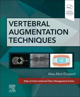 Gerinccsigolya-megnagyobbítási technikák - Vertebral Augmentation Techniques