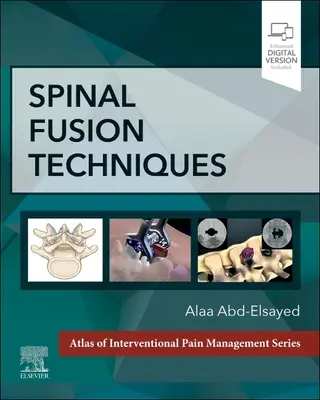 Gerincfúziós technikák - Spinal Fusion Techniques