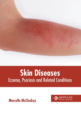 Bőrbetegségek: Ekcéma, pikkelysömör és kapcsolódó állapotok - Skin Diseases: Eczema, Psoriasis and Related Conditions