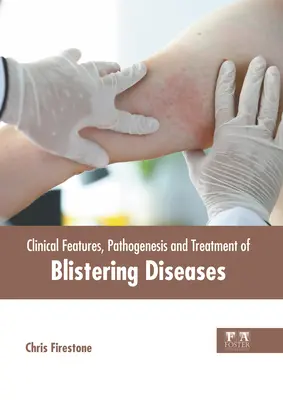 A hólyagosodási betegségek klinikai jellemzői, patogenezise és kezelése - Clinical Features, Pathogenesis and Treatment of Blistering Diseases