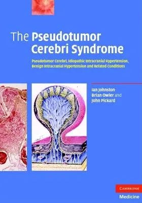 A Pseudotumor cerebri szindróma - The Pseudotumor Cerebri Syndrome