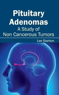 Hypophysis adenomák: A Study of Non Cancerous Tumors - Pituitary Adenomas: A Study of Non Cancerous Tumors