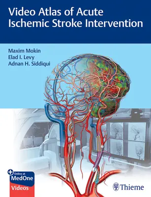 Az akut iszkémiás stroke beavatkozásának videoatlasza - Video Atlas of Acute Ischemic Stroke Intervention