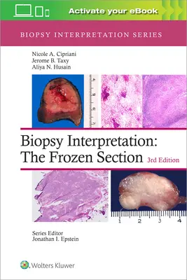 Biopszia értelmezése: A fagyasztott metszet - Biopsy Interpretation: The Frozen Section