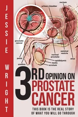 3. vélemény a prosztatarákról - 3rd Opinion on Prostate Cancer
