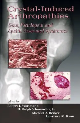 Crystal-Induced Arthropathies: Köszvény, álköszvény és apatit-asszociált szindrómák - Crystal-Induced Arthropathies: Gout, Pseudogout and Apatite-Associated Syndromes