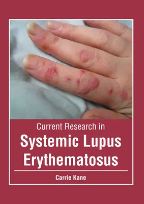 A szisztémás lupus erythematosus jelenlegi kutatása - Current Research in Systemic Lupus Erythematosus