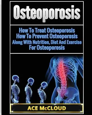 Csontritkulás: Hogyan kezeljük a csontritkulást: Hogyan előzzük meg a csontritkulást: Táplálkozással, diétával és testmozgással együtt a csontritkulás ellen. - Osteoporosis: How To Treat Osteoporosis: How To Prevent Osteoporosis: Along With Nutrition, Diet And Exercise For Osteoporosis