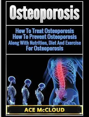 Csontritkulás: Hogyan kezeljük a csontritkulást: Hogyan előzzük meg a csontritkulást: Táplálkozással, diétával és testmozgással együtt a csontritkulás ellen. - Osteoporosis: How To Treat Osteoporosis: How To Prevent Osteoporosis: Along With Nutrition, Diet And Exercise For Osteoporosis