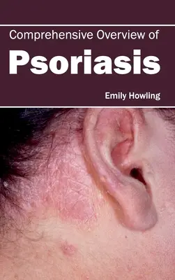 A pikkelysömör átfogó áttekintése - Comprehensive Overview of Psoriasis