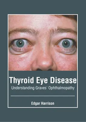 A pajzsmirigy szembetegsége: Graves-szemészeti betegség megértése - Thyroid Eye Disease: Understanding Graves' Ophthalmopathy