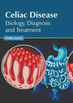 Cöliákia: Etiológia, diagnózis és kezelés - Celiac Disease: Etiology, Diagnosis and Treatment