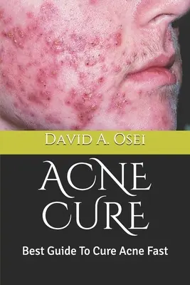 Akne gyógymód: A legjobb útmutató a pattanások gyors gyógyításához - Acne Cure: Best Guide To Cure Acne Fast