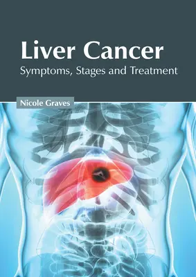 Májrák: Tünetek, szakaszok és kezelés - Liver Cancer: Symptoms, Stages and Treatment