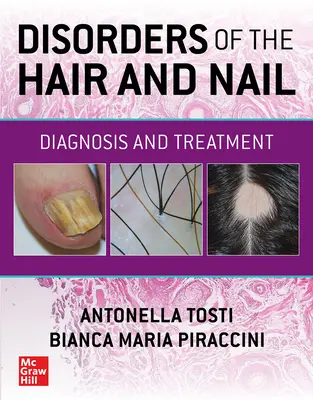 A haj és a köröm betegségei: Diagnózis és kezelés - Disorders of the Hair and Nail: Diagnosis and Treatment