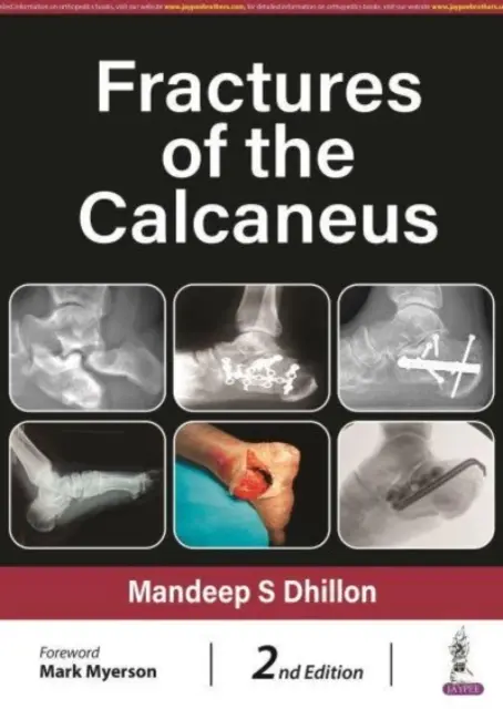 A sarkantyú törései - Fractures of the Calcaneus