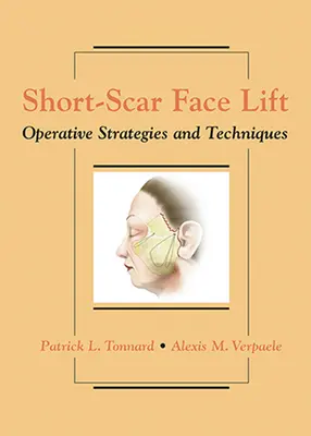 Short-Scar Face Lift: Operatív stratégiák és technikák - Short-Scar Face Lift: Operative Strategies and Techniques